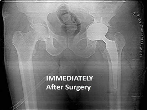 Revision Hip Replacement Surgery In Bangalore Symptoms Of Failed Hip