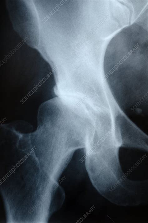 Osteoarthritis Of The Hip X Ray Stock Image C0155991 Science