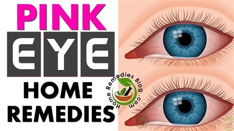 Pink Eye Treatment 10 Proven Home Remedies For Conjunctivitis Home