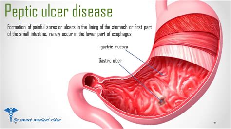 Peptic Ulcer Symptoms Signs Investigations And Complications Med Date