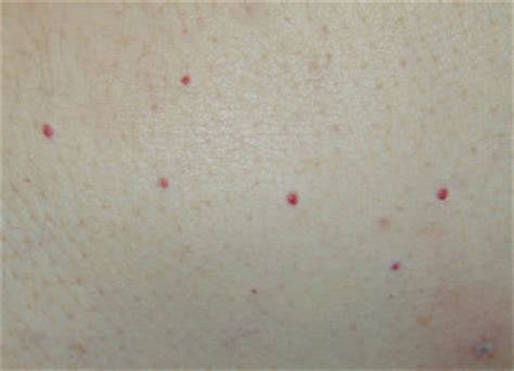 But it's important to get small dark red spots on your skin. How to Treat Dots, Bumps and Red Spots On Skin - Red Spots ...