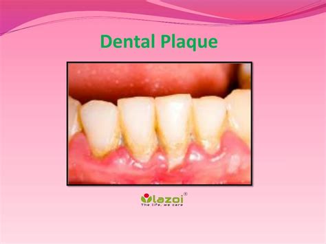Ppt Dental Plaque Powerpoint Presentation Free Download Id7945755