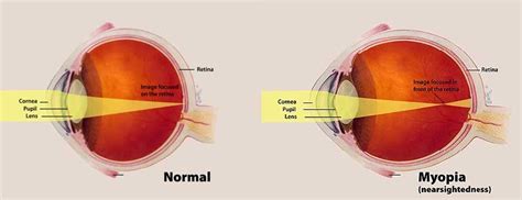 Controlling Myopia With Atropine 001 Eye Drops Toronto Markham
