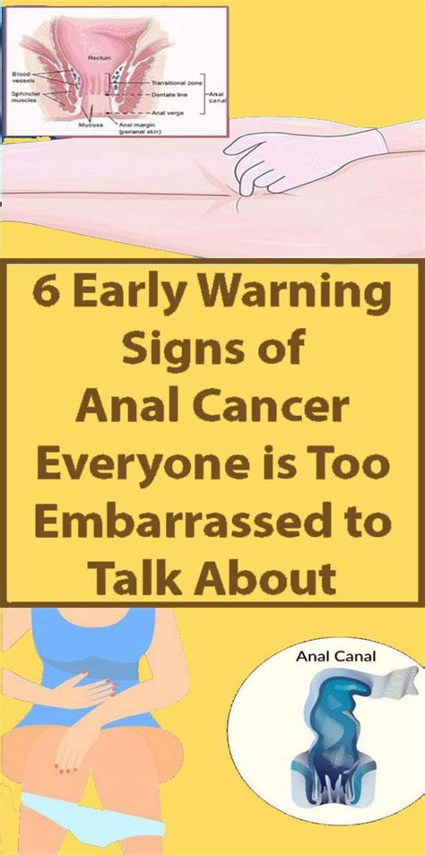 6 Unusual Signs Of Anal Cancer You Shouldnt Ignore Wellness Hero