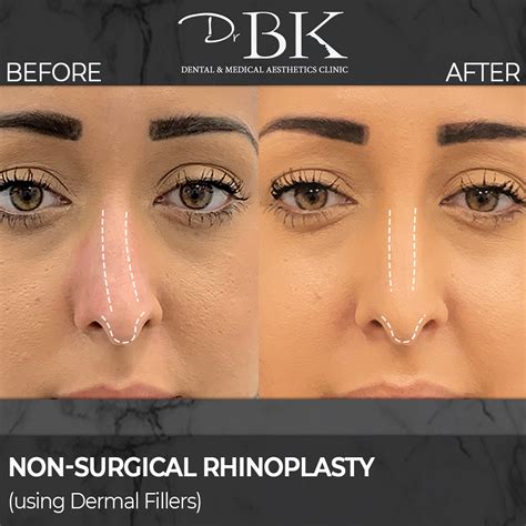 Non Surgical Rhinoplasty Drbk Award Winning Aesthetics Clinic