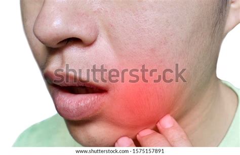 Painful Cheek Swelling Dental Abscess Lower Stok Fotoğrafı 1575157891