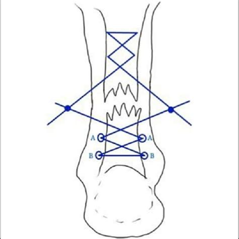 A Modified Bunnel Suture Configuration Was Used For The Procedure A Download Scientific