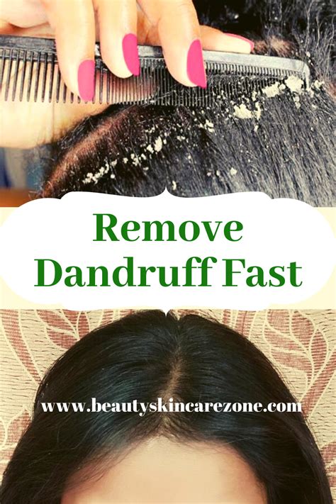 How To Remove Dandruff Fast In 2020 How To Remove Dandruff Dry Hair