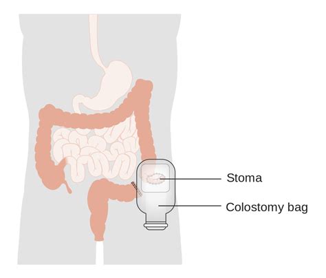Category Colostomy Accurate Ostomate