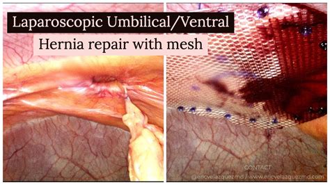 Laparoscopic Umbilicalventral Hernia Repair With Mesh Youtube