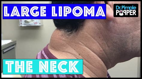 Lipoma Removal Surgery