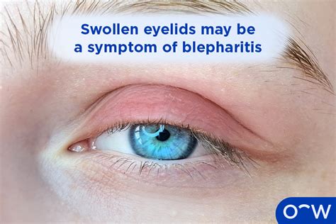 Blepharitis Types Causes Symptoms Diagnosis And Treatments