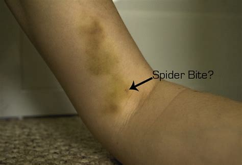 Bonddustbacphi Spider Bite Pictures Early Stages