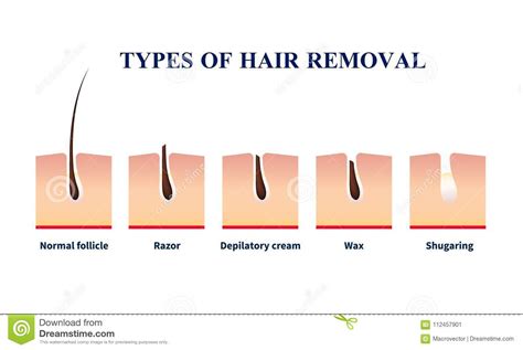 Webmd explains different hair removal techniques, such as waxing, threading, and laser hair removal. Types Of Hair Removal Illustration Stock Vector ...
