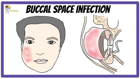 Buccal Space Infection Boundaries Clinical Features Management