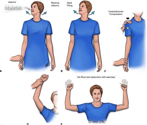 Figure 10 From A Hand Surgeons Further Experience With Thoracic Outlet