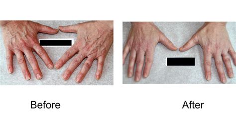 Hand Vein Treatments In Waunakee Wi