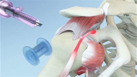 Right Shoulder Rotator Cuff Repair And Biceps Tenodesis Animation Youtube