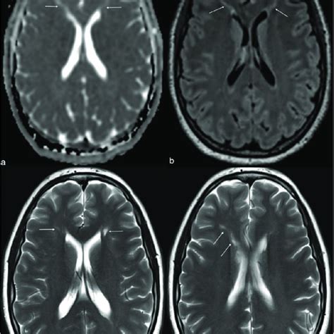 Examples Of Brain Mri And Mrs Findings In Adult Patients With