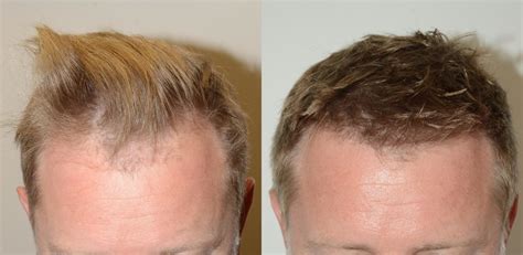 Hair Transplants For Men Before And After Photos Foundation For Hair Restoration