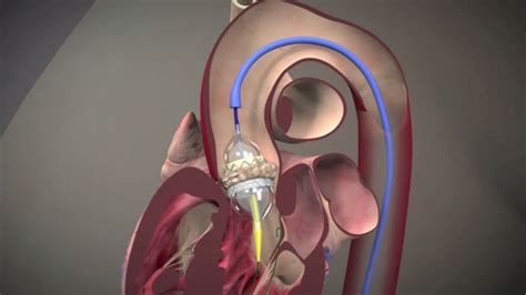 Tavr An Option For Inoperable Aortic Stenosis Broadcastmed