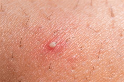 Ingrown Hair Overview Symptoms Causes And Proven Remedies Factdr