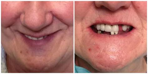 Immediate Upper And Lower Dentures Vernon Denture Clinic