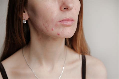 Post Inflammatory Erythema How To Treat Acne Red Spots The Healthy