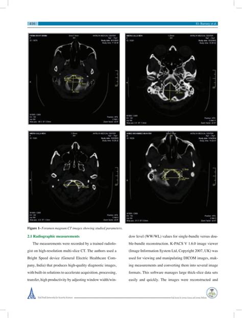 sex prediction using foramen magnum and occipital condyles computed tomography measurements in