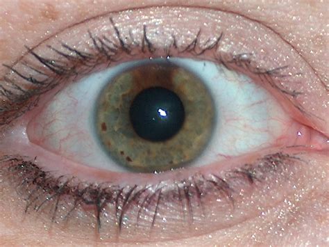 Central Heterochromia Iridis