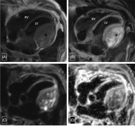 Four Chamber T1‐weighted A And T2‐weighted B Turbo Spin‐echo Images Download Scientific