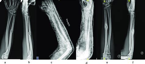 Ap And Lateral Radiographs Of A Representative Case Managed By Long Arm