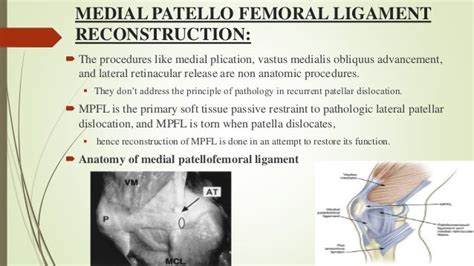 Dynamic Medial Patellofemoral Ligament Reconstruction In Recurrent Pa
