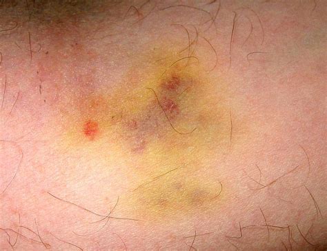 What Is A Hematoma Que Es Un Hematoma Answers