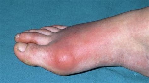 Rates Of Gout In Uk Soaring Bbc News