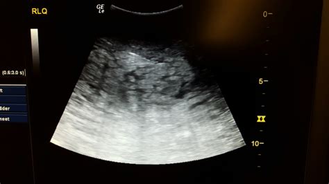 Abdominal Cellulitis Loma Linda Ultrasound