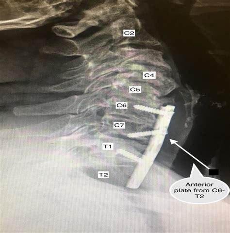 Lateral X Ray Showing The Anterior Cervical Plate Received By This