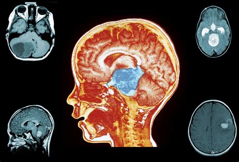Cancer As Related To Brain Tumor Pictures