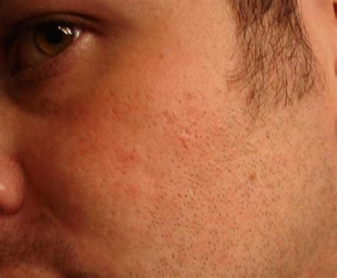 Scar Logs My Scars Left Cheek Image 1 Pictures And Videos