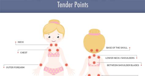 Fibromyalgia Tender Points What And Where Are The Tender Points Of