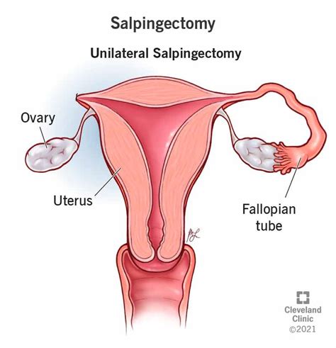 Salpingectomy Purpose Procedure Risks And Recovery