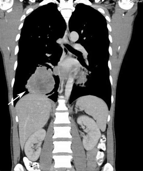 Computed Tomography Ct Coronal View Of Our Patients Thorax And