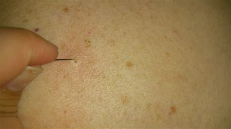 Digging Out The Blackhead Dry Pimple Blackhead Removal Dilated Pore On