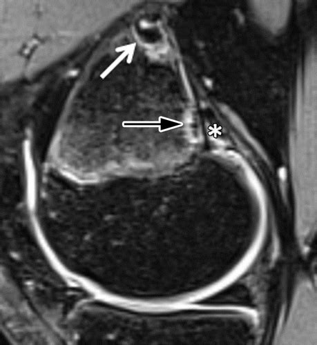 Mri Detected Bony Lesions Common And Benign In Young Athletes Knees
