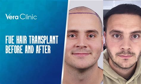 FUE Hair Transplant Before And After Vera Clinic