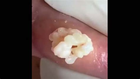 Sebaceous Cyst With White Pus Drained New Pimple Popping Videos My