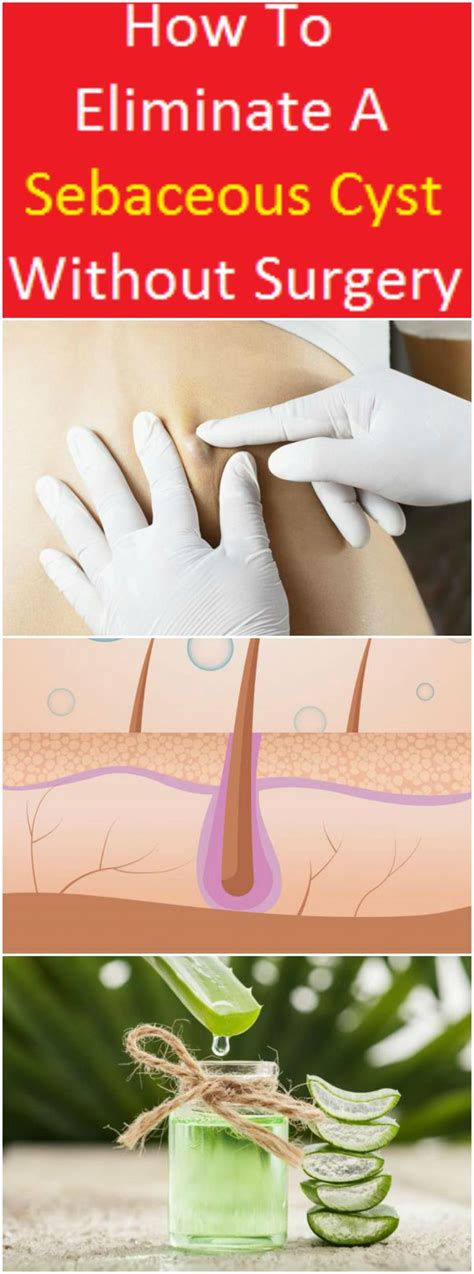 How To Eliminate A Sebaceous Cyst Without Surgery Very Effective