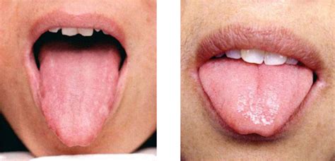 Pale Thin Tongue In Tcm Tongue Diagnosis