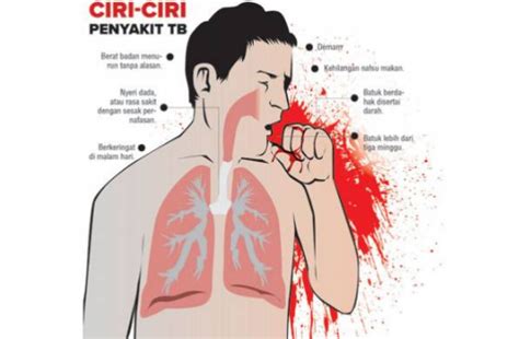 Tuberculosis Tbc Penyebab Gejala Dan Pencegahan Lengkap Riset