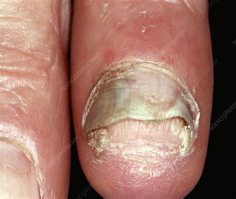 Psoriasis Of The Fingernail Stock Image C0509840 Science Photo